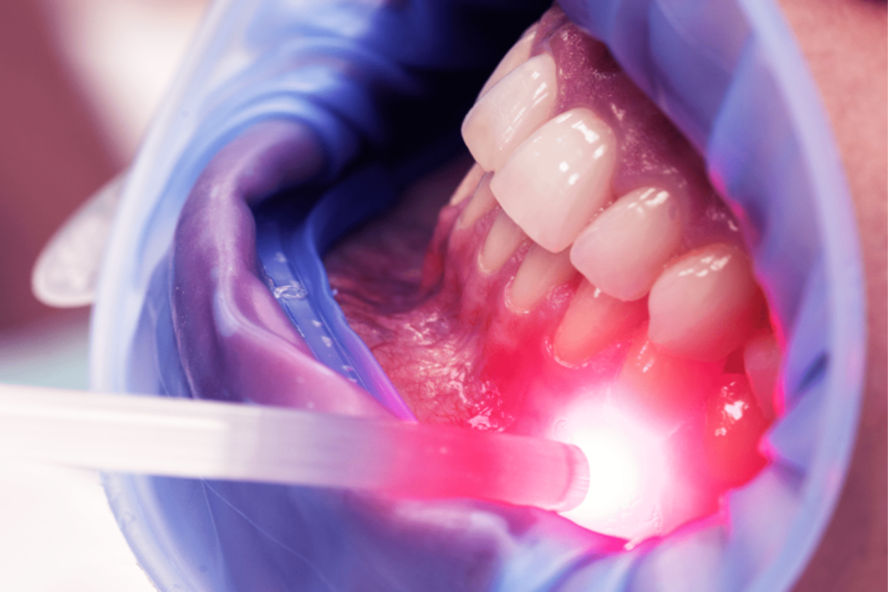 Aplicação de laser de baixa potência em tratamento odontológico